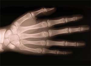 hand xray