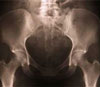 hip xray