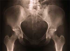 hip xray