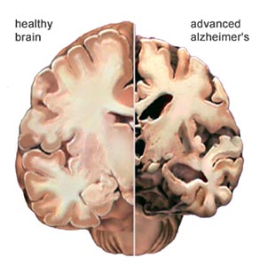 Dietary Fats and the Brain